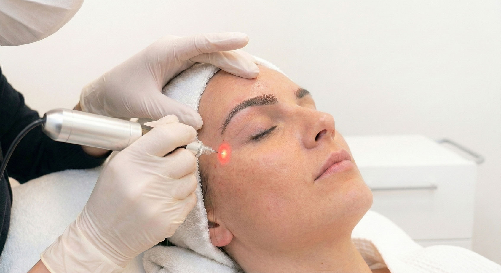 Aknebehandlung mit Laser Interlaken